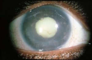 GLAUCOMA - facts, definition, types, causes/risk factors, signs and symptoms, diagnosis, prevention and treatment