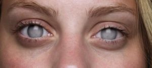 Absolute Glaucoma