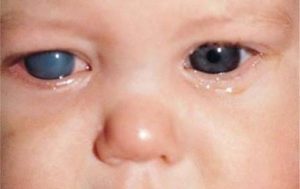 Congenital Glaucoma