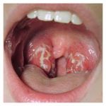 Gonorrhea infection
